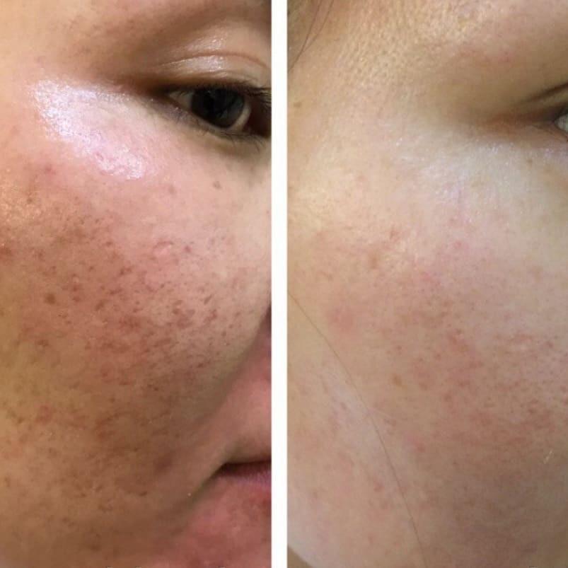 before and after of DermaLaser CO₂