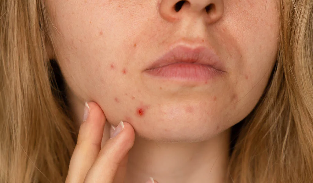 what-is-post-acne-hyperpigmentation