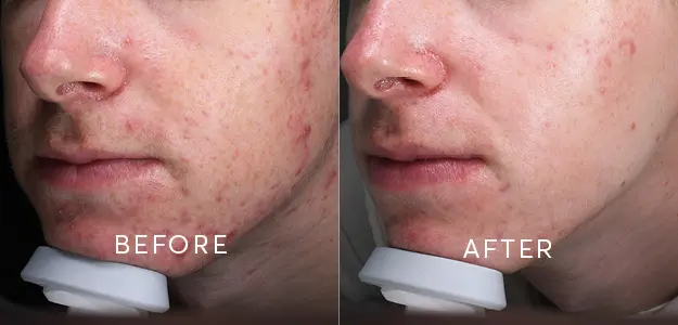 Can LED Light Therapy Really Improve Post-Acne Pigmentation?