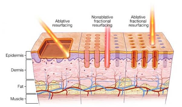 The 3 Types of Fractional CO2 Laser Tips 