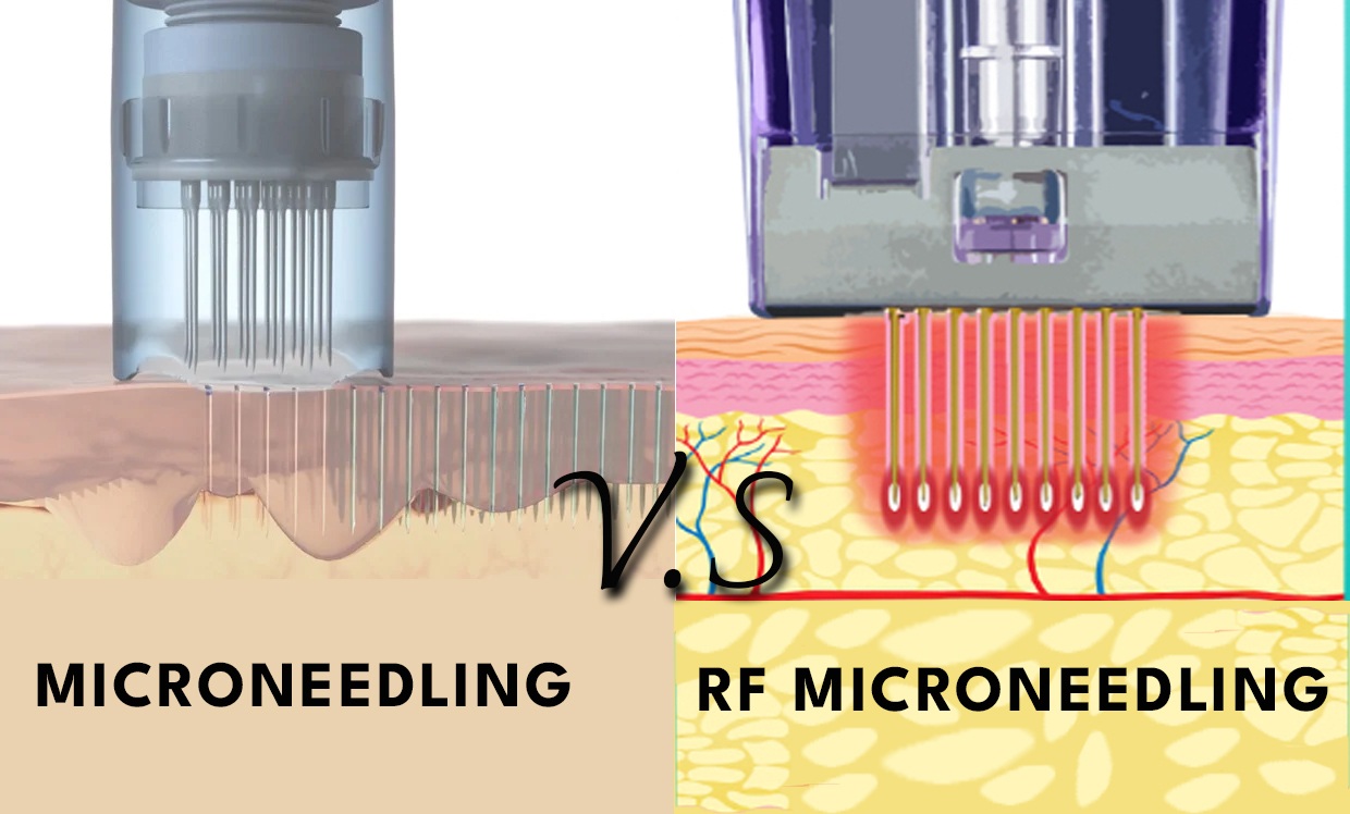 microneedling vs rf microneedling(1) microneedling vs rf microneedling(1)