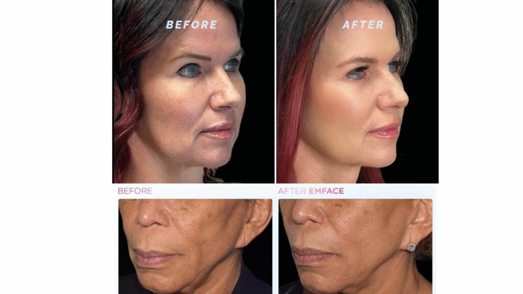 Before&after of DermaTone EMS Lift