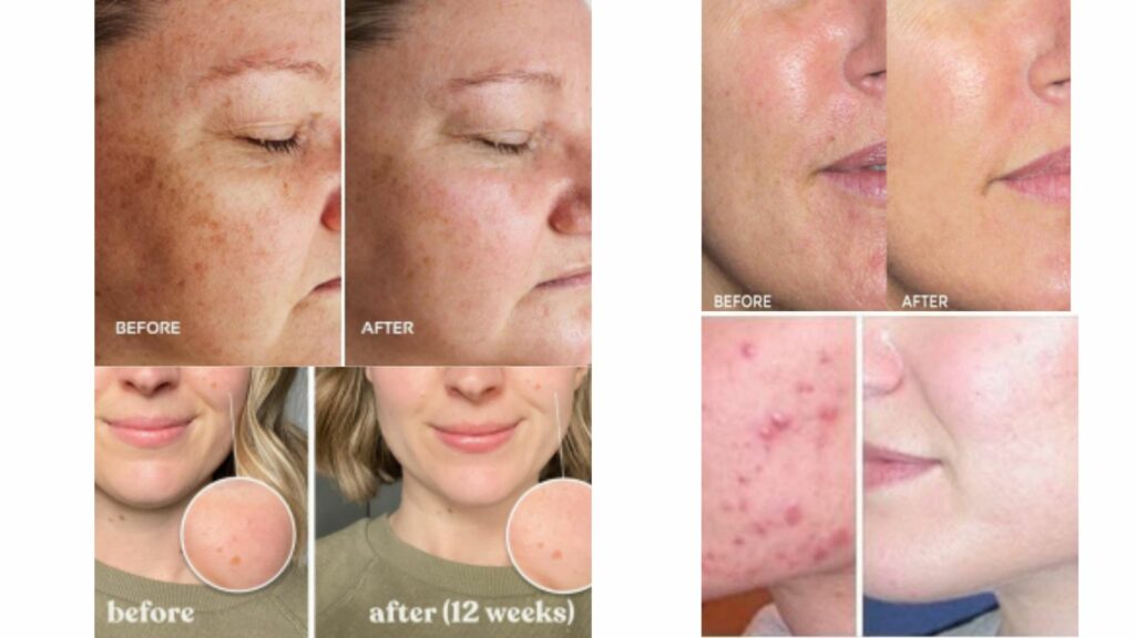 beforeafter LED light therapy