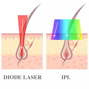 IPL vs IPL vs