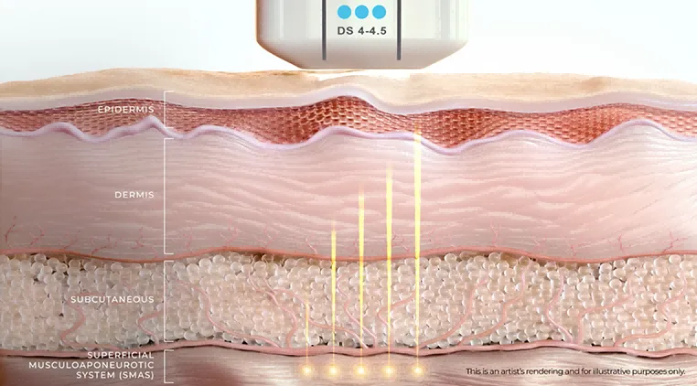 how does ultherapy work how does ultherapy work