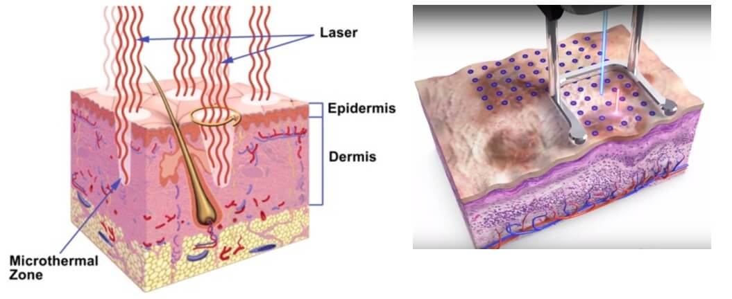 how does fractional CO2 laser work? how does fractional CO2 laser work?