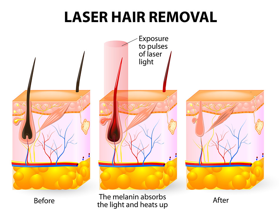 how diode lasers hair removal work
