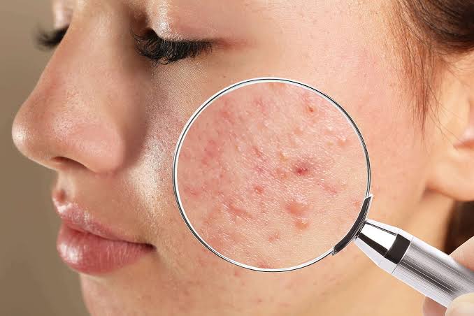 Acne Treatment Solution Acne Treatment Solution