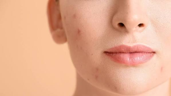 Acne Treatment Solutions Acne Treatment Solutions